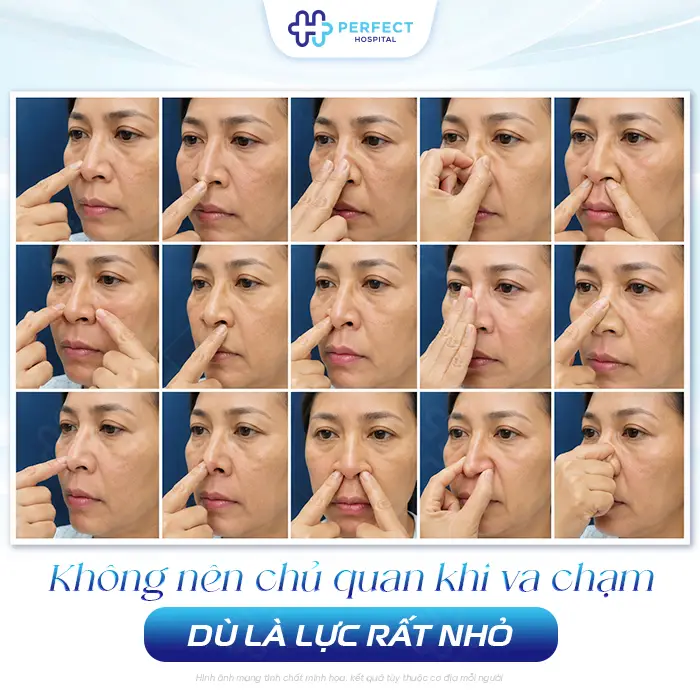 Nâng Mũi Bị Va Chạm Có Sao Không? Cách Xử Lý An Toàn