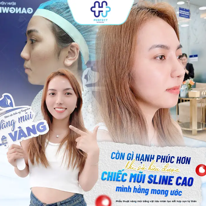 Phương Pháp Nâng Mũi Bọc Megaderm Là Gì? Có Nên Thực Hiện Không?
