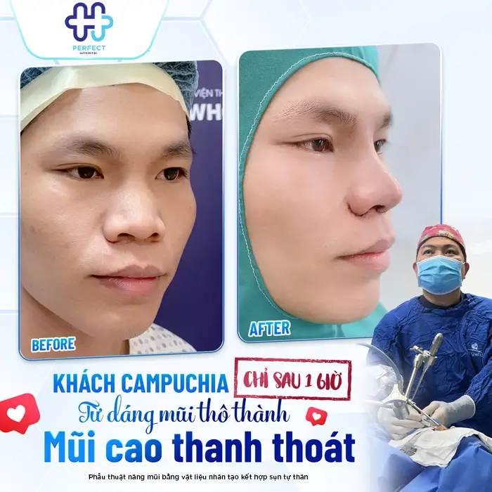 Phương Pháp Nâng Mũi Bọc Megaderm Là Gì? Có Nên Thực Hiện Không?
