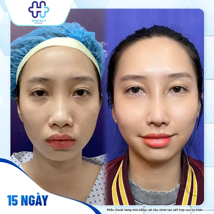 Phương Pháp Nâng Mũi Bọc Megaderm Là Gì? Có Nên Thực Hiện Không?
