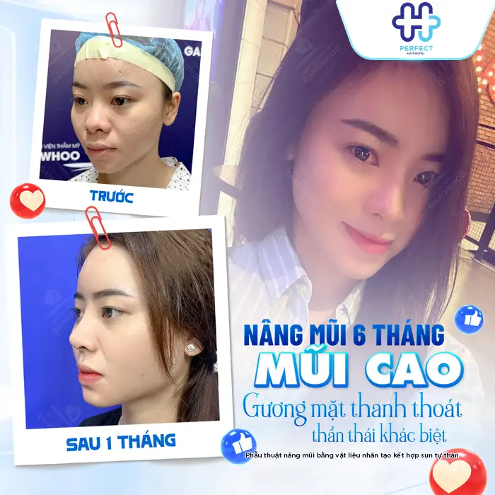 Phương Pháp Nâng Mũi Bọc Megaderm Là Gì? Có Nên Thực Hiện Không?