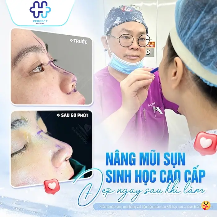 Phương Pháp Nâng Mũi Bọc Megaderm Là Gì? Có Nên Thực Hiện Không?