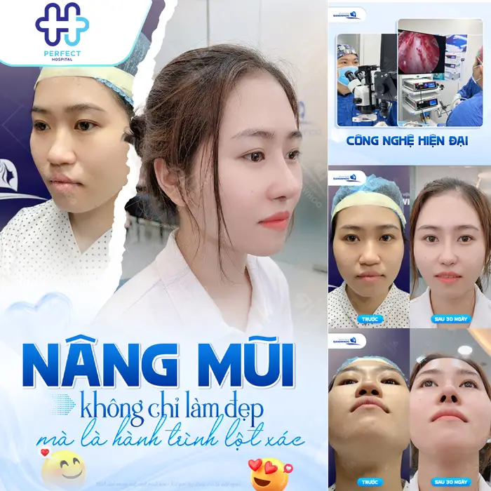 Nâng Mũi Cao Tự Nhiên Là Gì? Cách Sở Hữu Dáng Mũi Đẹp