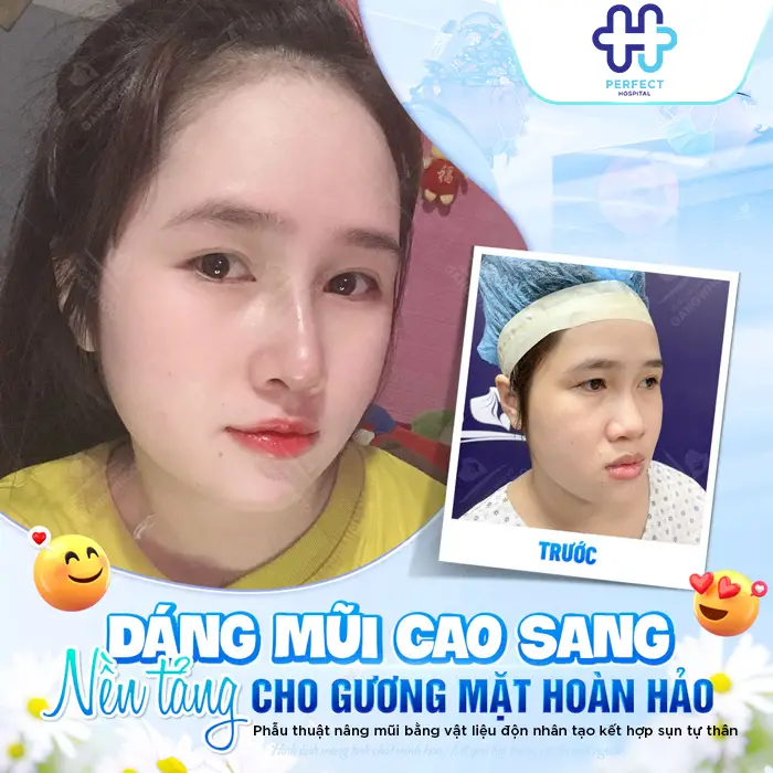 Nâng Mũi Cao Tự Nhiên Là Gì? Cách Sở Hữu Dáng Mũi Đẹp