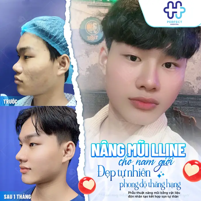 Nâng Mũi Cao Tự Nhiên Là Gì? Cách Sở Hữu Dáng Mũi Đẹp
