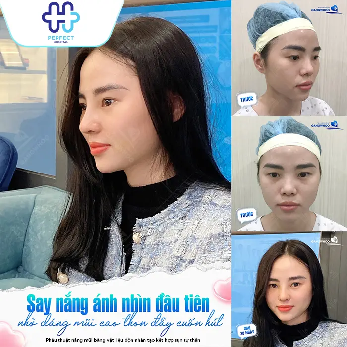 Nâng Mũi Cao Tự Nhiên Là Gì? Cách Sở Hữu Dáng Mũi Đẹp