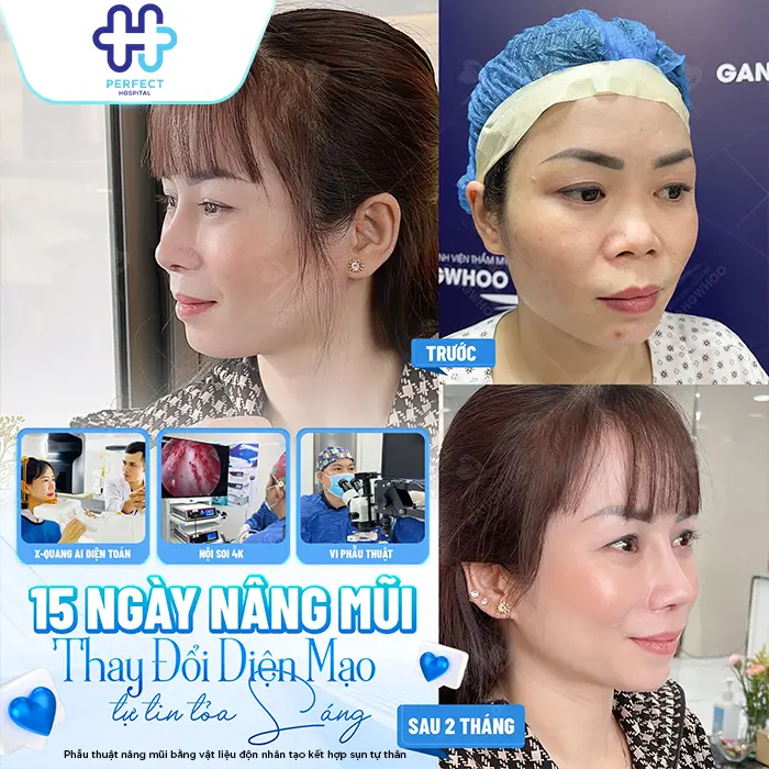 Nâng Mũi Cao Tự Nhiên Là Gì? Cách Sở Hữu Dáng Mũi Đẹp