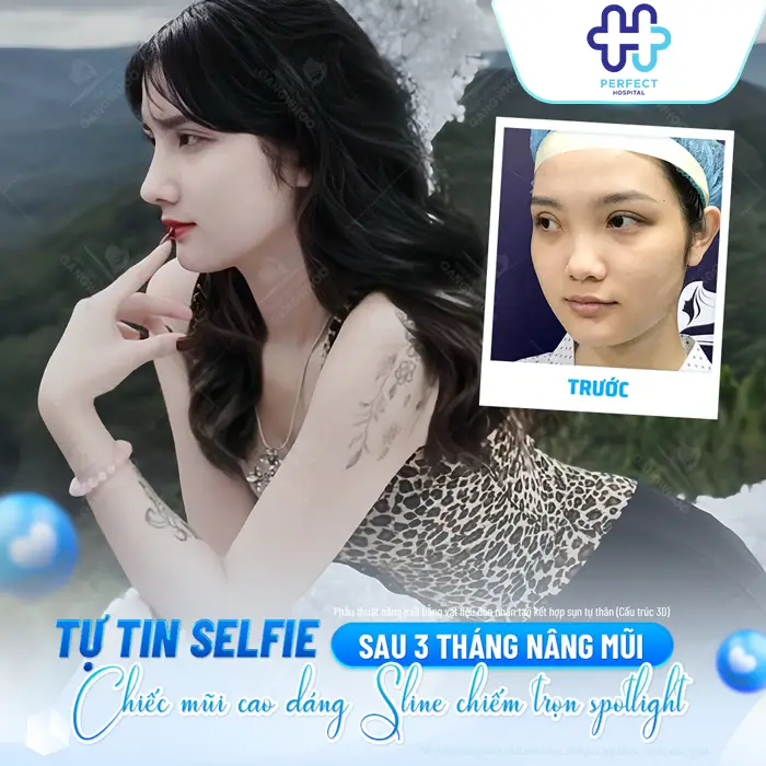 Nâng Mũi Bán Cấu Trúc 4D Là Gì? Công Nghệ Model 4D Mới Nhất