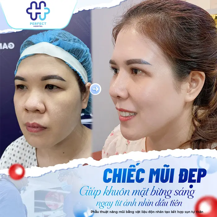 Nâng Mũi Bán Cấu Trúc 4D Là Gì? Công Nghệ Model 4D Mới Nhất