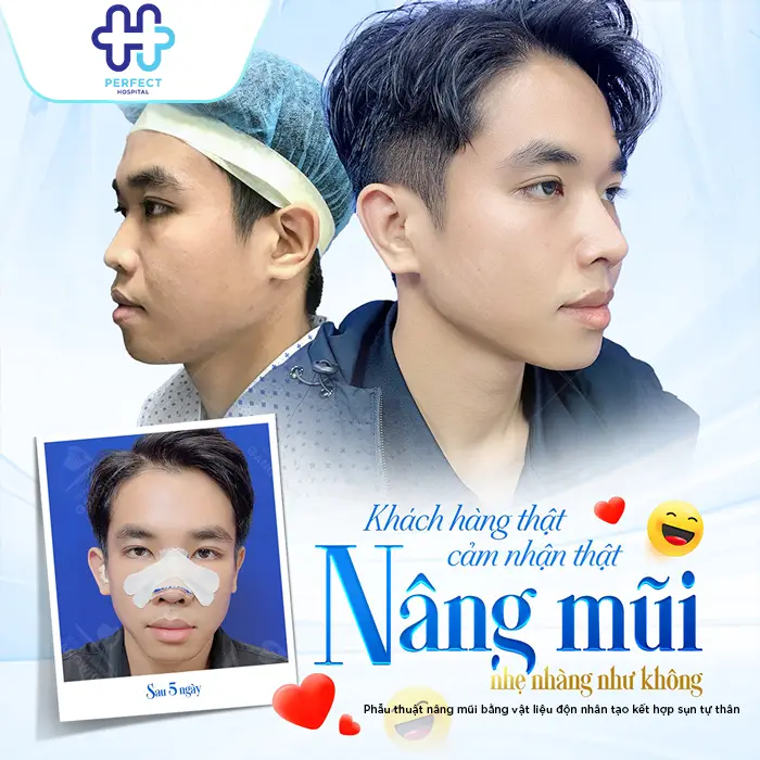 Nâng Mũi Bán Cấu Trúc 4D Là Gì? Công Nghệ Model 4D Mới Nhất