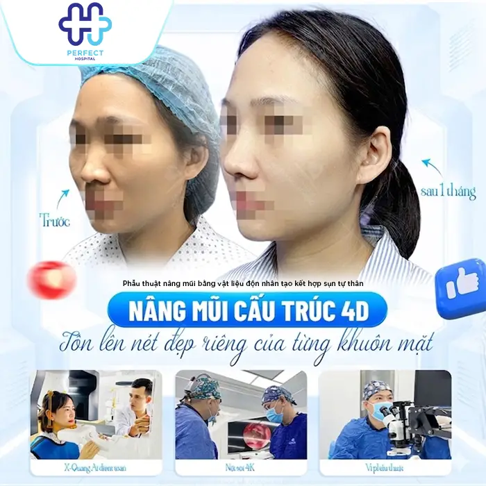 Nâng Mũi Bán Cấu Trúc 4D Là Gì? Công Nghệ Model 4D Mới Nhất