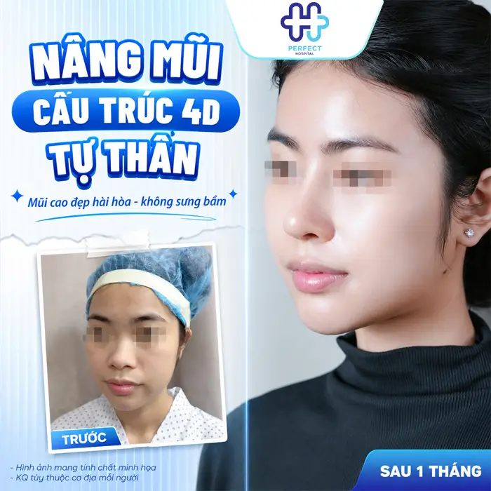 Nâng Mũi Cấu Trúc 4D Tự Thân Là Gì? Có Nên Thực Hiện Không?