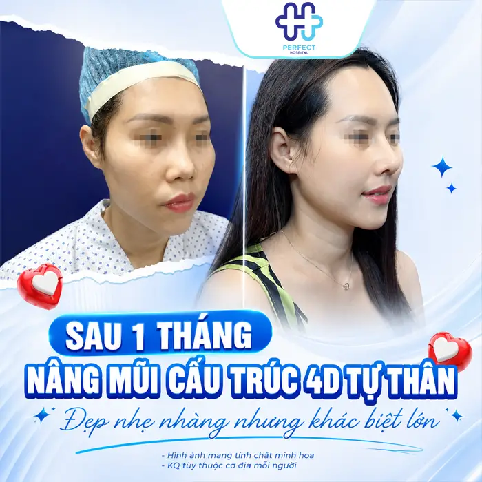 Nâng Mũi Cấu Trúc 4D Tự Thân Là Gì? Có Nên Thực Hiện Không?
