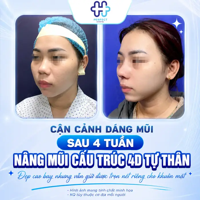 Nâng Mũi Cấu Trúc 4D Tự Thân Là Gì? Có Nên Thực Hiện Không?