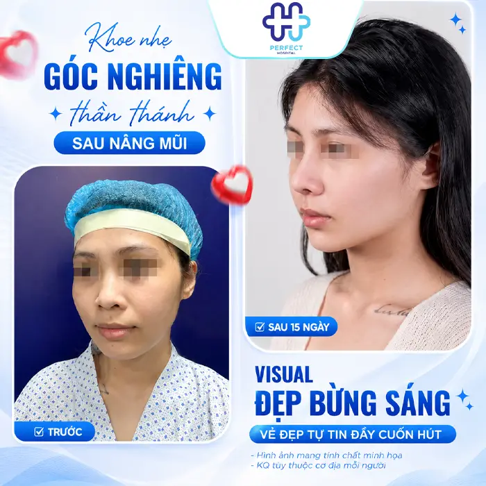 Nâng Mũi Cấu Trúc 4D Tự Thân Là Gì? Có Nên Thực Hiện Không?
