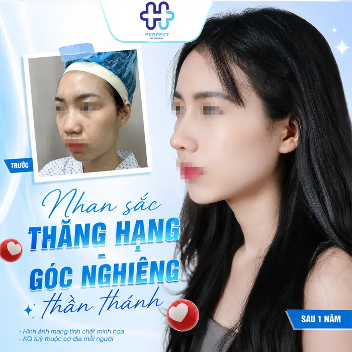 Nâng Mũi Cấu Trúc 4D Tự Thân Là Gì? Có Nên Thực Hiện Không?