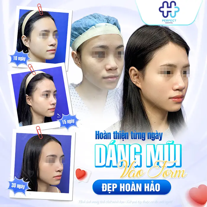 Nâng Mũi Cấu Trúc Bao Lâu Thì Gom Lại Và Vào Form Đẹp?