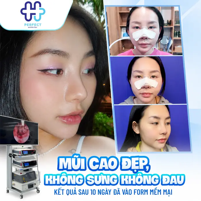 Nâng Mũi Cấu Trúc Bao Lâu Thì Gom Lại Và Vào Form Đẹp?