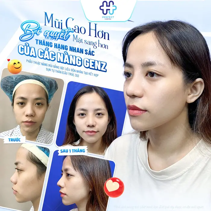 Nâng Mũi Cấu Trúc Có An Toàn Không? Giải Đáp Từ Chuyên Gia