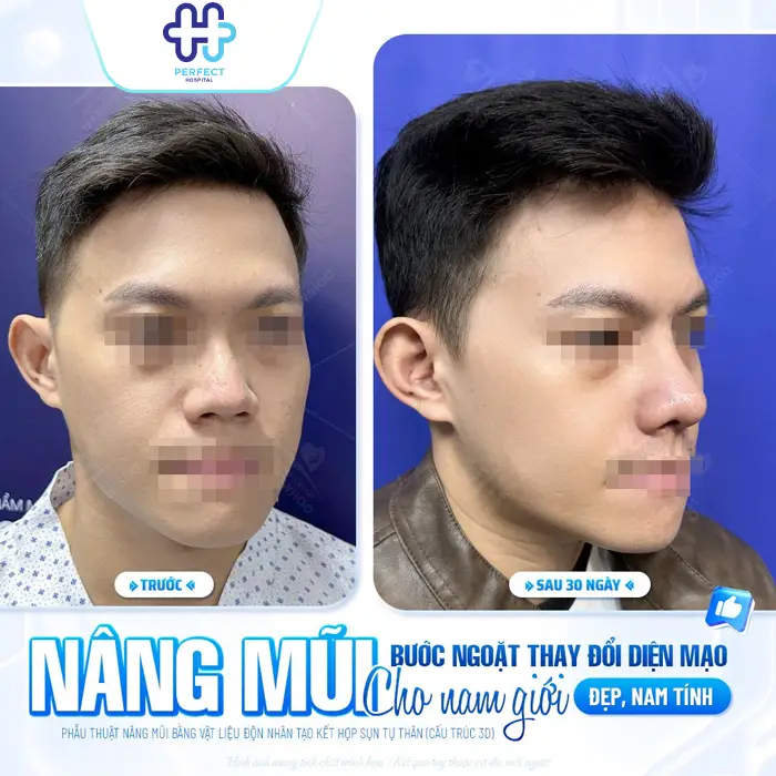 Nâng Mũi Cấu Trúc Có An Toàn Không? Giải Đáp Từ Chuyên Gia