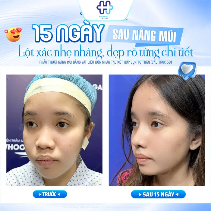 Nâng Mũi Cấu Trúc Có An Toàn Không? Giải Đáp Từ Chuyên Gia