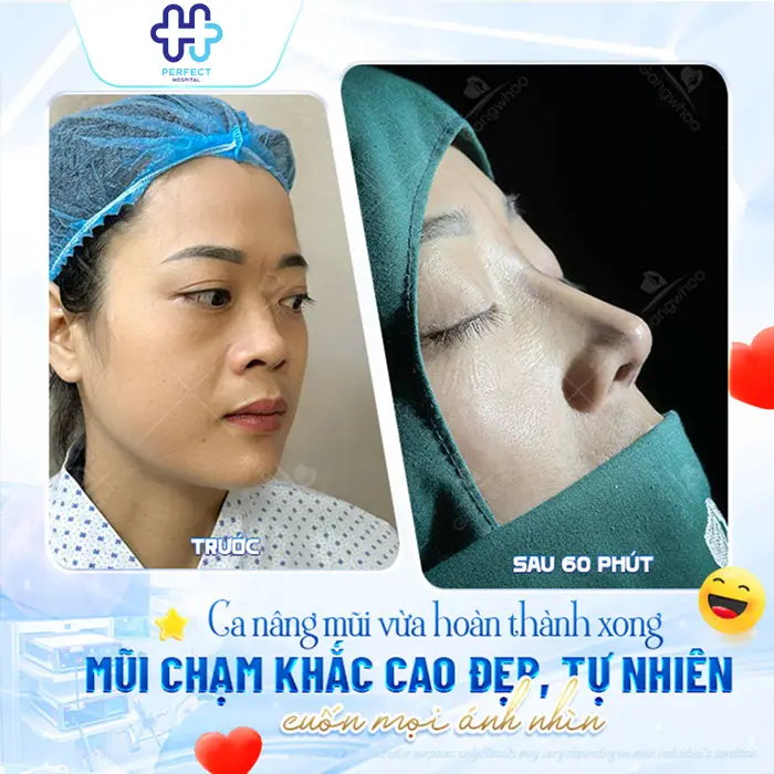 Nâng Mũi Khắc Chạm Là Gì? Công Nghệ Tạo Dáng Mũi Tinh Xảo