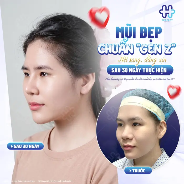 Nâng Mũi Khắc Chạm Là Gì? Công Nghệ Tạo Dáng Mũi Tinh Xảo