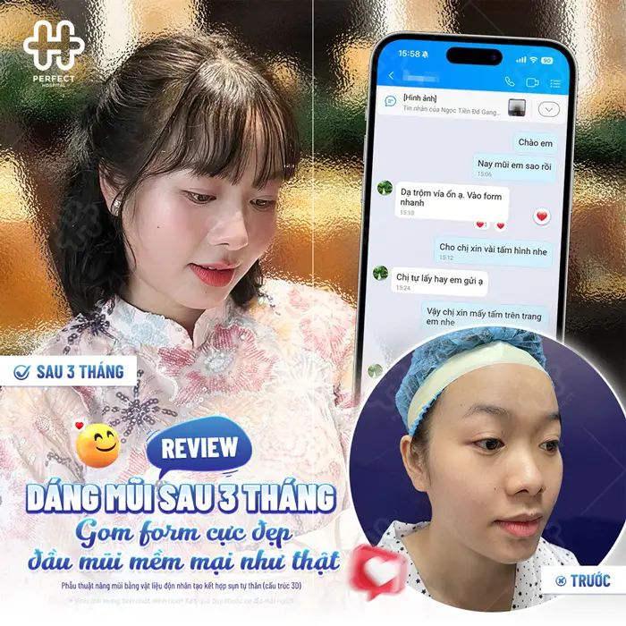 Nâng Mũi Khắc Chạm Là Gì? Công Nghệ Tạo Dáng Mũi Tinh Xảo
