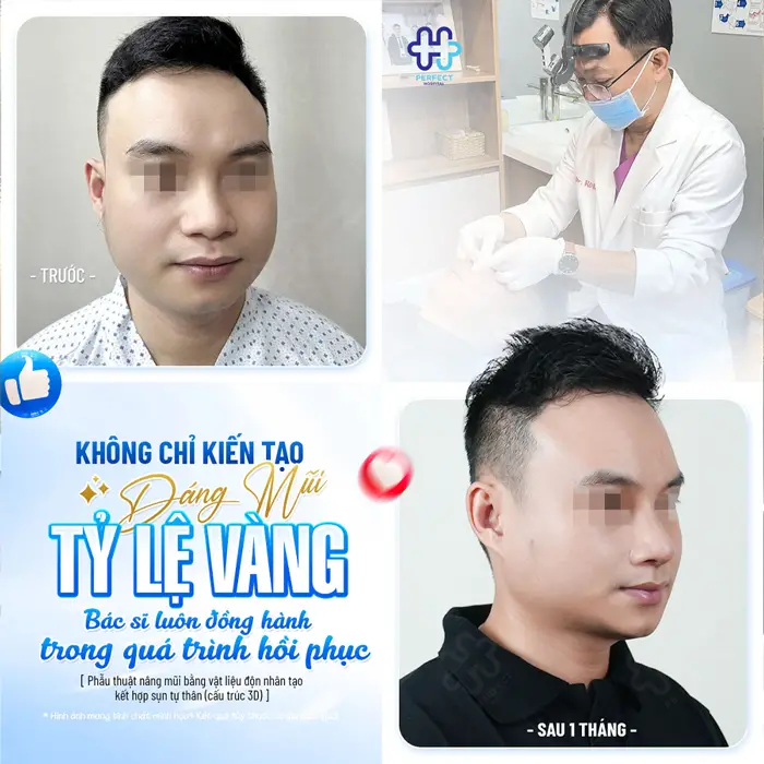 Nâng Mũi Khắc Chạm Là Gì? Công Nghệ Tạo Dáng Mũi Tinh Xảo