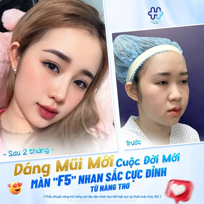 Nâng Mũi Khắc Chạm Là Gì? Công Nghệ Tạo Dáng Mũi Tinh Xảo