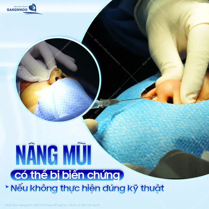 Nâng Mũi Chỉ Có Biến Chứng Không? Có Nên Thực Hiện Hay Không?