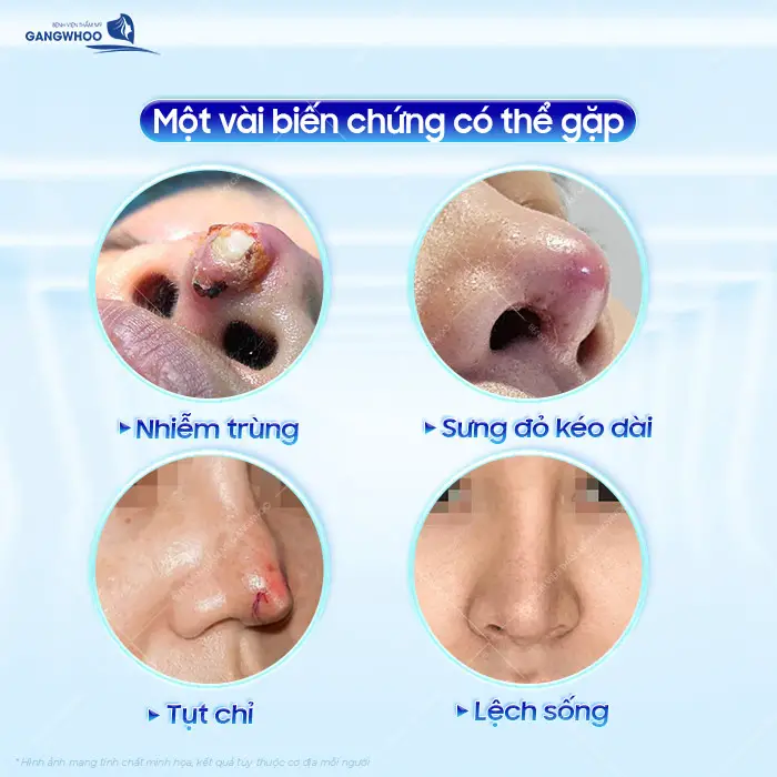 Nâng Mũi Chỉ Có Biến Chứng Không? Có Nên Thực Hiện Hay Không?