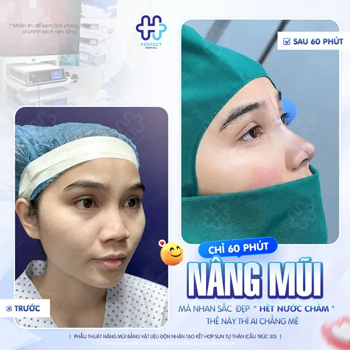 Nâng Mũi Chỉ Có Biến Chứng Không? Có Nên Thực Hiện Hay Không?