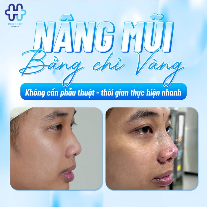 Nâng Mũi Chỉ Vàng Có Tốt Không? Sự Thật Về Chỉ Vàng 24K Trong Thẩm Mỹ