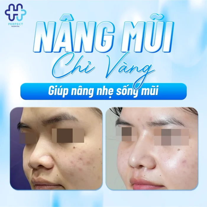 Nâng Mũi Chỉ Vàng Có Tốt Không? Sự Thật Về Chỉ Vàng 24K Trong Thẩm Mỹ