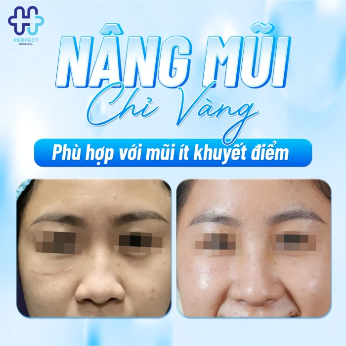 Nâng Mũi Chỉ Vàng Có Tốt Không? Sự Thật Về Chỉ Vàng 24K Trong Thẩm Mỹ