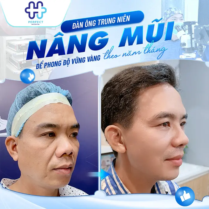 Nâng Mũi Chỉ Xoắn Kép Là Gì Có Tốt Không Và Có Nên Thực Hiện