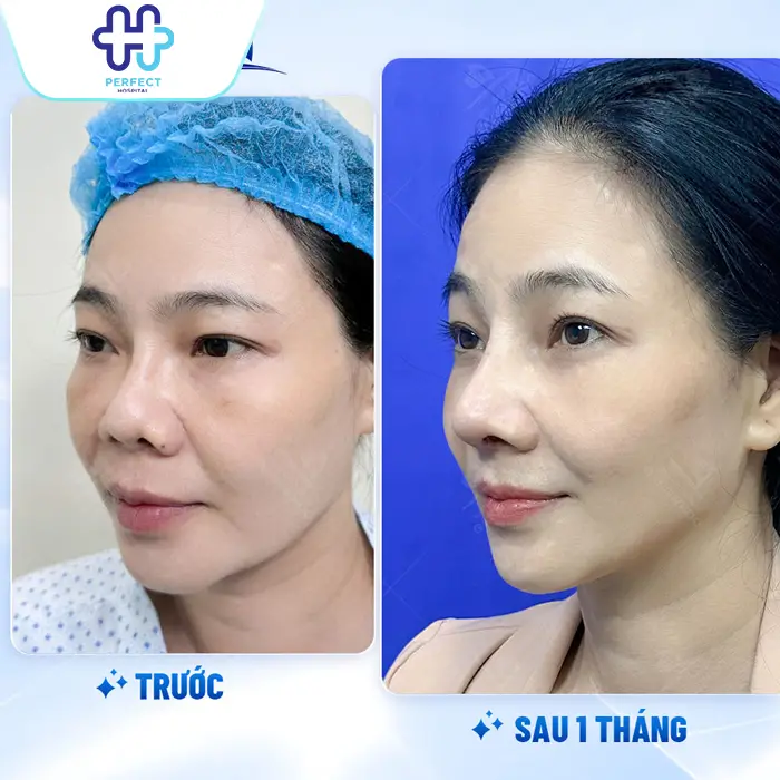 Nâng Mũi Chỉ Xoắn Kép Là Gì Có Tốt Không Và Có Nên Thực Hiện