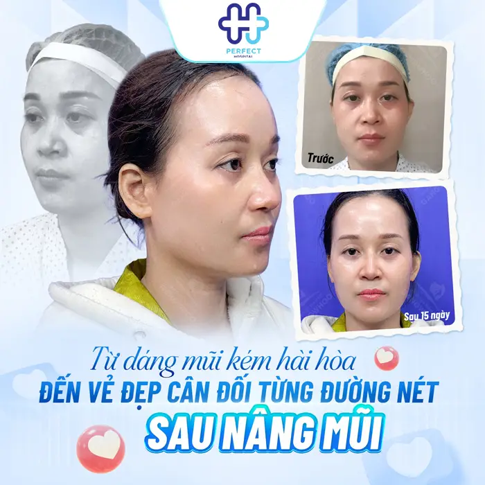 Nâng Mũi Chỉ Xoắn Kép Là Gì Có Tốt Không Và Có Nên Thực Hiện