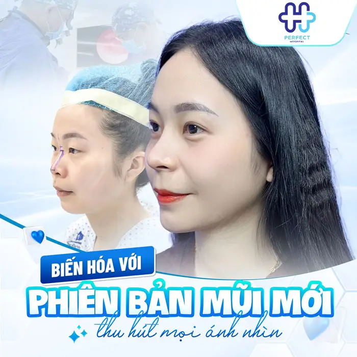 Nâng Mũi Chỉ Xoắn Kép Là Gì Có Tốt Không Và Có Nên Thực Hiện