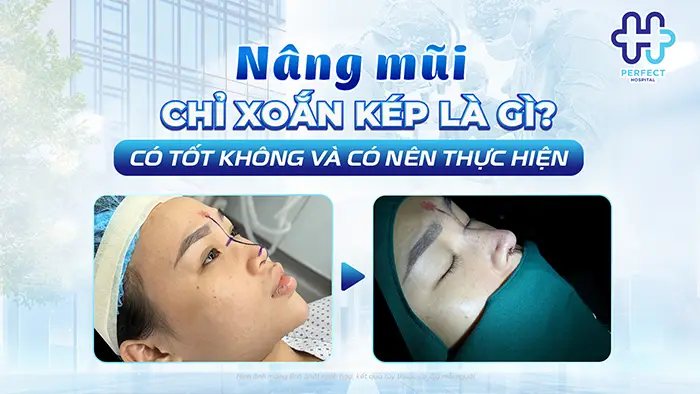 Nâng Mũi Chỉ Xoắn Kép Là Gì Có Tốt Không Và Có Nên Thực Hiện