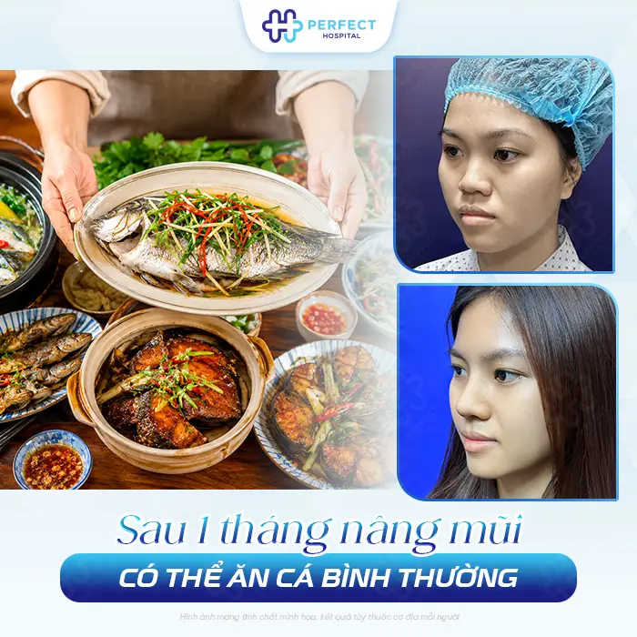 Nâng Mũi Có Được Ăn Cá Không? Có Nên Ăn Ngay Sau Phẫu Thuật