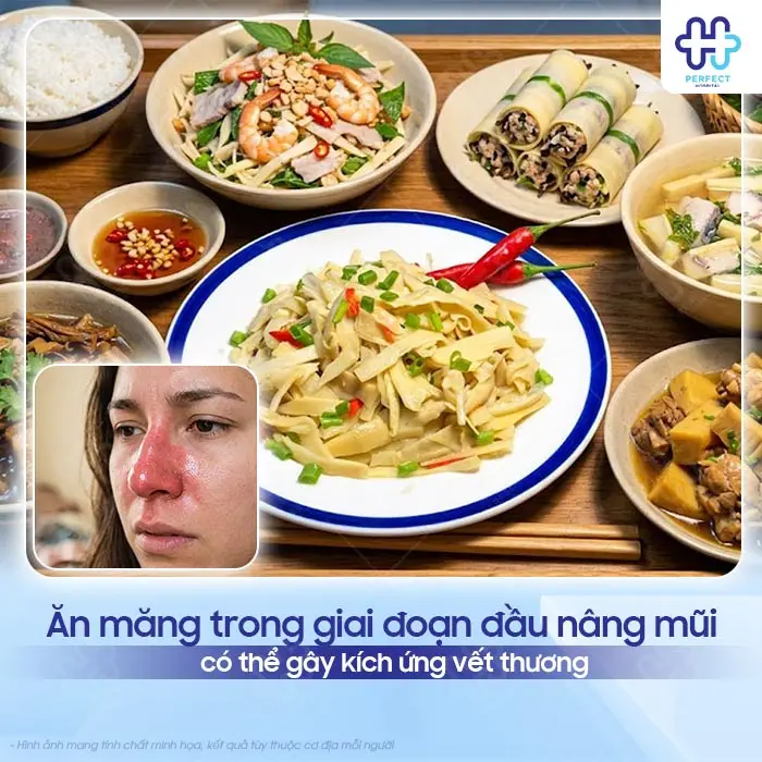 Nâng Mũi Có Được Ăn Măng Không? Giải Đáp Và Lưu Ý Quan Trọng