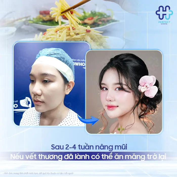 Nâng Mũi Có Được Ăn Măng Không? Giải Đáp Và Lưu Ý Quan Trọng