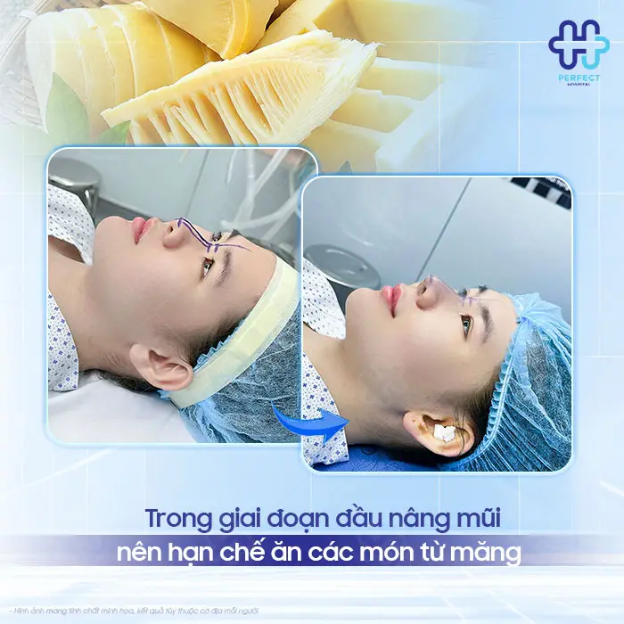 Nâng Mũi Có Được Ăn Măng Không? Giải Đáp Và Lưu Ý Quan Trọng