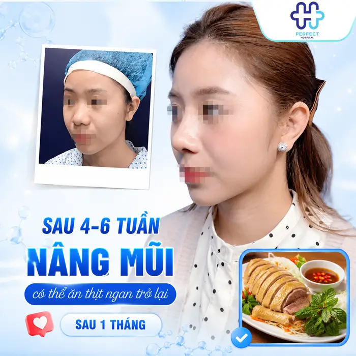 Nâng Mũi Có Ăn Được Thịt Ngan Không? Bao Lâu Thì Ăn Lại An Toàn