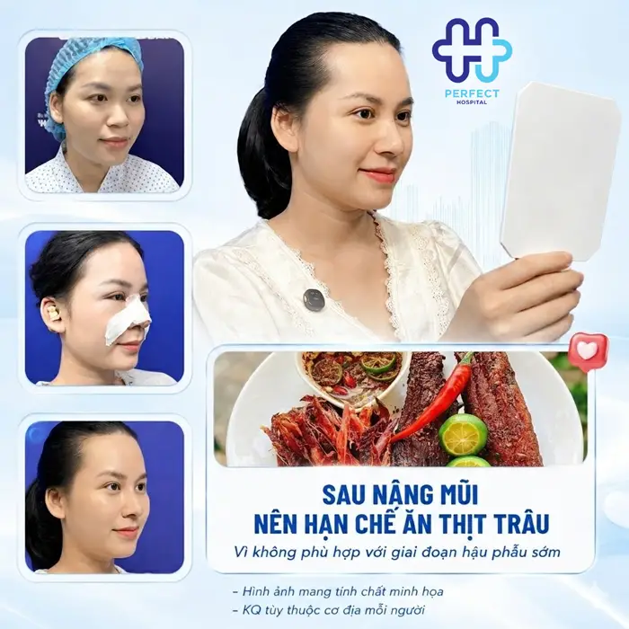 Nâng Mũi Có Ăn Được Thịt Trâu Không? Giải Đáp Từ Perfect Hospital