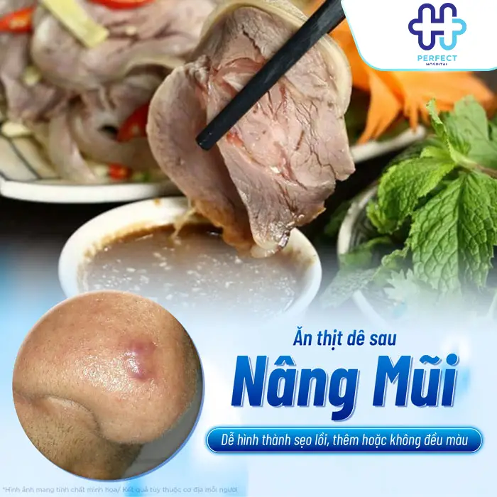 Nâng Mũi Có Ăn Thịt Dê Được Không? Bác Sĩ Perfect Hospital Giải Đáp