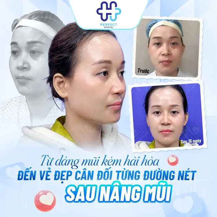 Nâng mũi có ảnh hưởng gì không? Có hại về sau không?
