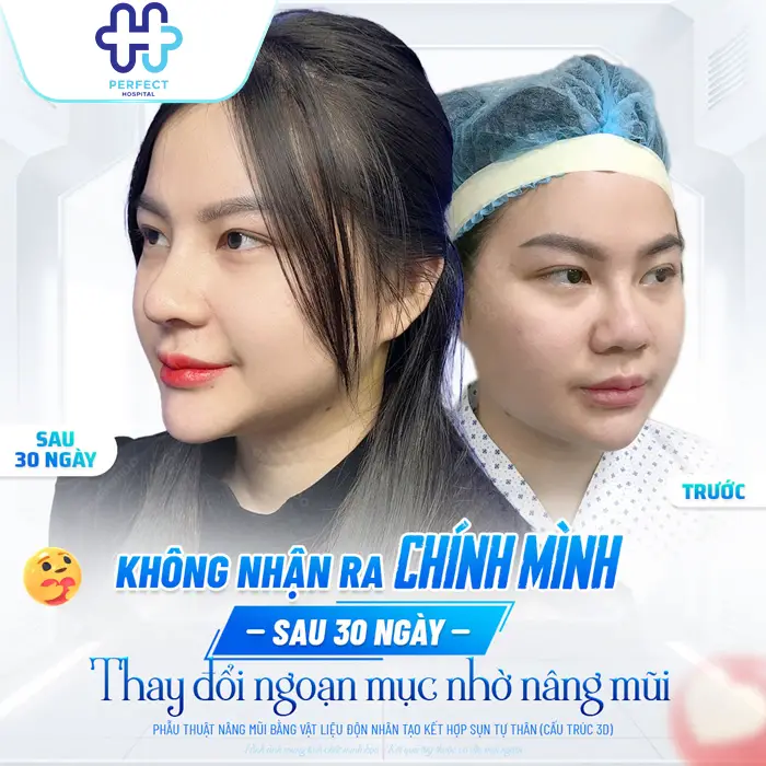 Nâng mũi có ảnh hưởng gì không? Có hại về sau không?